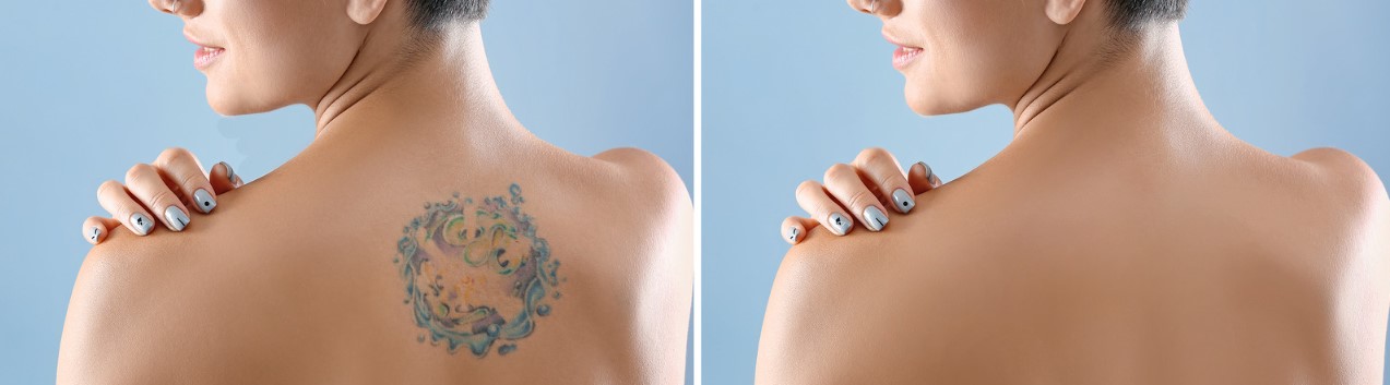 The Different Types of Non-Laser Tattoo Removal Methods